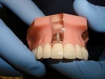 Implant-with-crown