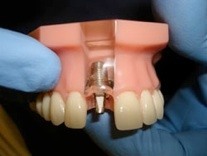 Implant-without-crown