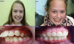 A young girl photographed before and after her Fastbraces treatment.